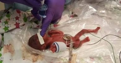MIRACLE BABY World’s smallest newborn who weighed same as an APPLE at just 8.6oz survives after parents are told she’d only live for an hour